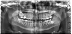 Digital-dental-x-rays